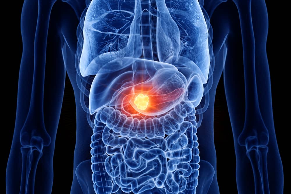 Here are signs of pancreatic cancer you can look out for 