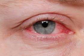 A new Covid variant, which has been found to be more infectious, is said to have an added rare symptom of conjunctivitis or pinkeye. 