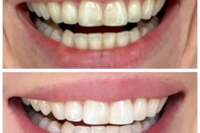 Teeth before and after