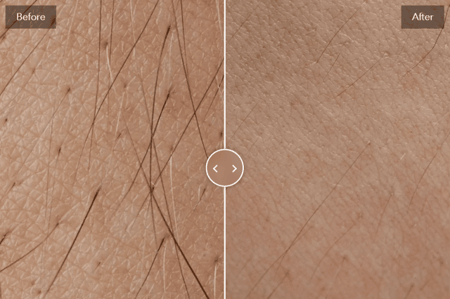 Before and after use by a Keskine IPL Hair Removal Handset