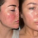 Before and after images of 47 Skin user Jamie