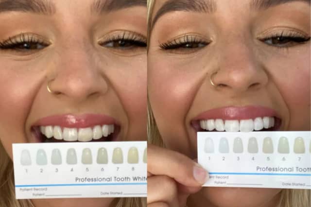 How I transformed my smile with the SmilePro advanced teeth whitening kit (aff)