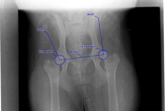 Rosie's X-Ray shows the abnormal development of her hips. Photo: Gemma Dowson