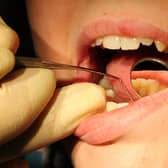 NHS England data shows a steep drop in people visiting the dentist in 2020 and 2021, with millions across England missing check-ups and treatment. Photo: PA Images