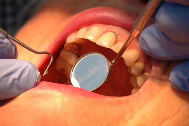 Office for Health Improvement and Disparities figures show that around 10 children aged 19 or younger in the East Riding had at least one tooth removed in hospital due to decay in 2020-21. Photo: PA Images
