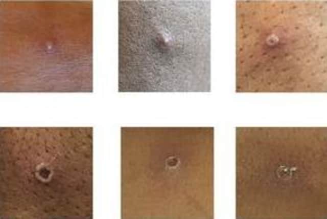 The latest UKHSA figures put the number of confirmed monkeypox cases in the UK at 78 as of Tuesday (May 24).