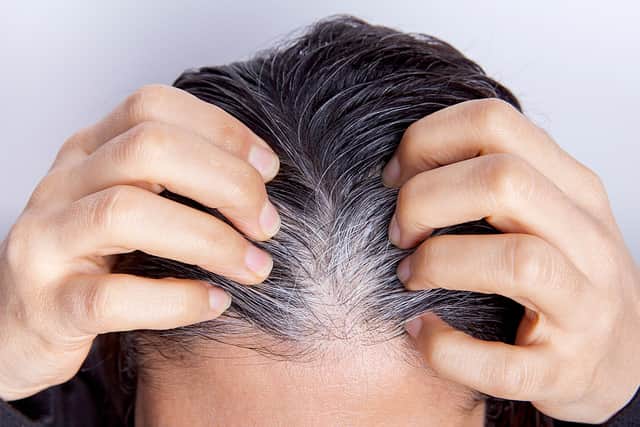For hair strands to grow grey or white they have to grow out from the root or the follicle. Yet science has now shown that stress can indeed cause the change to be rapid. Photo: AdobeStock