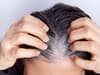 Dr's Casebook: Stress really can make hair go grey
