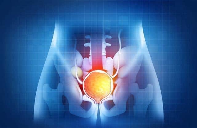 Prostate cancer is the most common cancer in men in the UK.