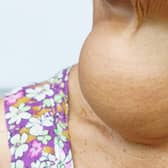 Woman with enlarged hyperthyroid gland. Photo: AdobeStock