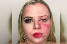 Beth Smith is a YouTuber from Bridlington who documents online her journey with the chronic disease Lupus. Photo: Beth Smith.