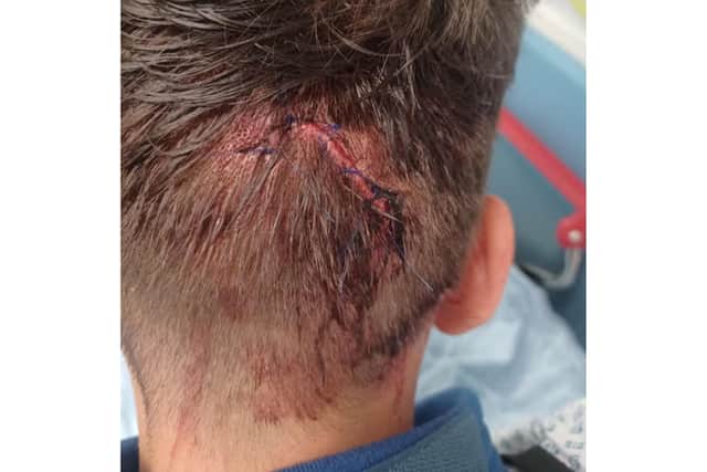 Police have shared a graphic image of one of the victim's injuries - Image: North Yorkshire Police