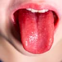 Tongue of a child with scarlet fever - strawberry tongue.
picture: Adobe.