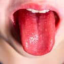 Tongue of a child with scarlet fever - strawberry tongue.
picture: Adobe.