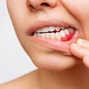 The commonest sign that it is present is soreness in the gums and bleeding when brushing the teeth. Photo: AdobeStock