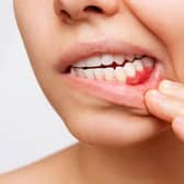 The commonest sign that it is present is soreness in the gums and bleeding when brushing the teeth. Photo: AdobeStock