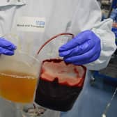 Plasma separated out from red blood cells.