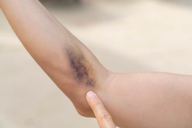 Bruises typically change colour as they heal, at first appearing red, purple, or darker than the surrounding skin. Photo: AdobeStock