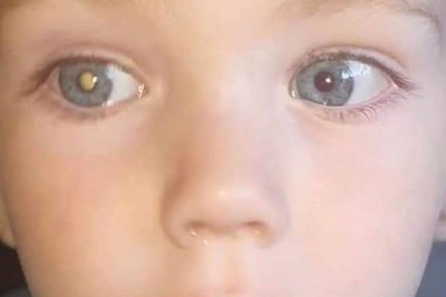 Retinoblastoma patient Harvey with a key symptom - ‘white eye’ or ‘glow’.