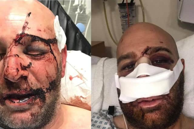 John before and after treatment for his facial injuries