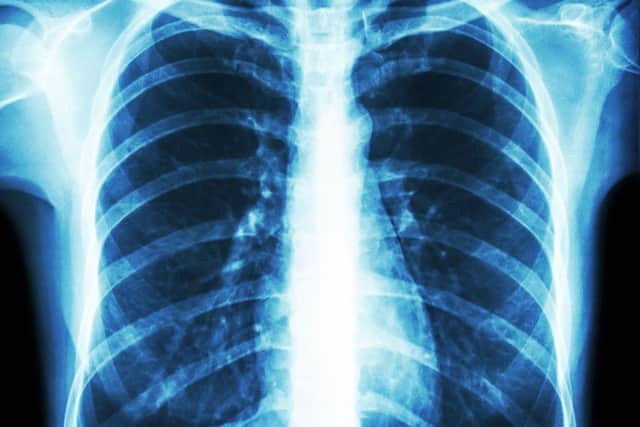 The survival rate of lung cancer patients is below the national average, according to ONS figures.