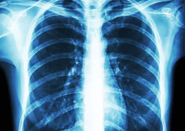 The survival rate of lung cancer patients is below the national average, according to ONS figures.