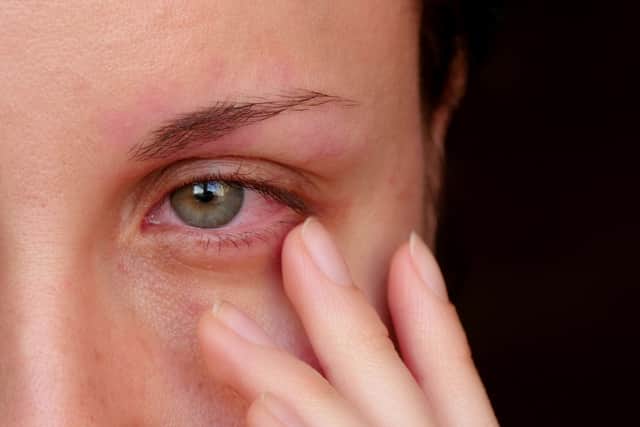 Sore, itchy eyes may be a warning sign of a Covid-19 infection (Photo: Shutterstock)